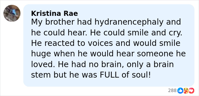 Woman Born Without Most Of Her Brain Turns 20, Family Speaks Out And It Sparks A Heated Debate Woman Born Without Most Of Her Brain Turns 20, Family Speaks Out And It Sparks A Heated Debate