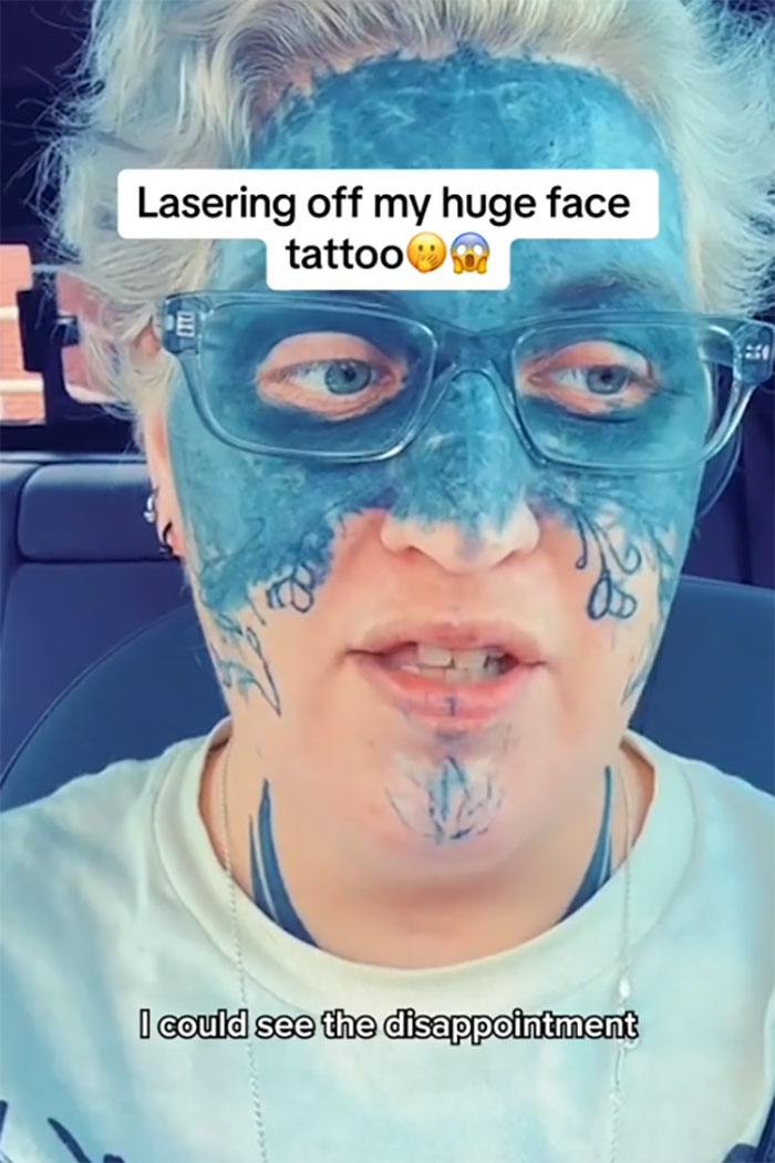 Brave Woman Shares Story Of Removing Unwanted Face Tattoo After Cruel Prank Brave Woman Shares Story Of Removing Unwanted Face Tattoo After Cruel Prank