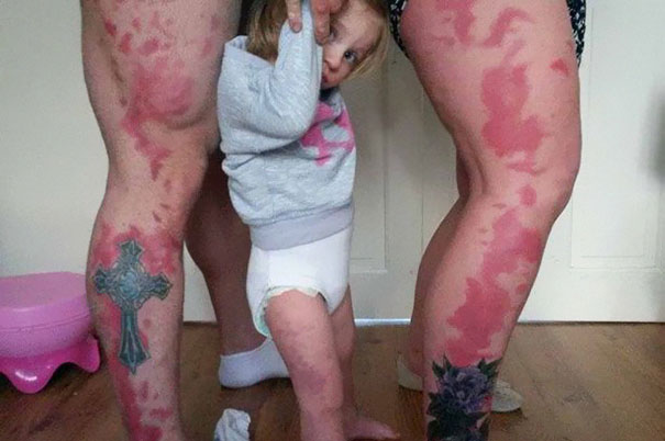 Parents Tattoo Their Legs With Daughter&#8217;s Birthmark So She Won&#8217;t Feel Different