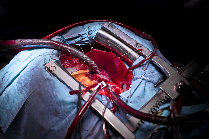 Gentle Violence: A Visual Exploration Of The Body During Open Heart Surgeries Gentle Violence: A Visual Exploration Of The Body During Open Heart Surgeries