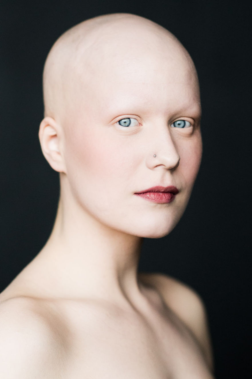 Baldvin: I Photograph Women With Alopecia To Break Gender Stereotypes Baldvin: I Photograph Women With Alopecia To Break Gender Stereotypes