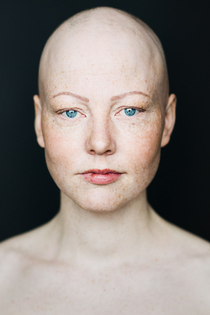 Baldvin: I Photograph Women With Alopecia To Break Gender Stereotypes Baldvin: I Photograph Women With Alopecia To Break Gender Stereotypes