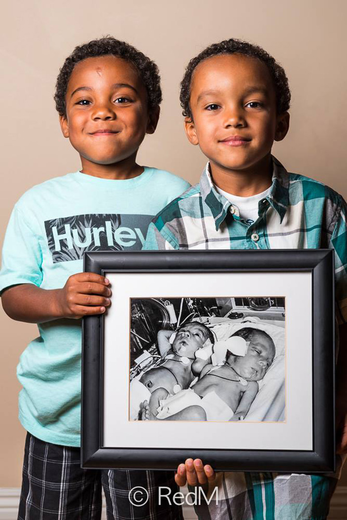 Powerful Before-And-After Portraits Of Premature Babies