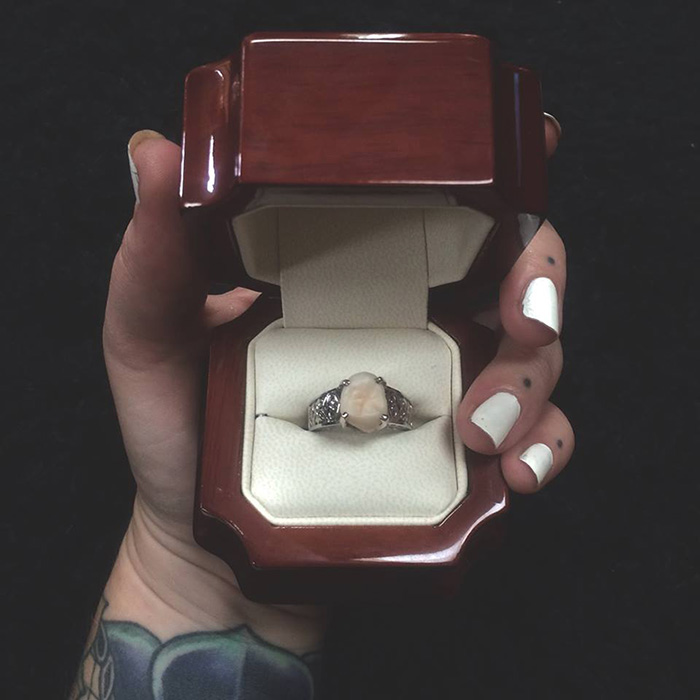 This Woman Got An Engagement Ring With Her Fiance&#8217;s Wisdom Tooth