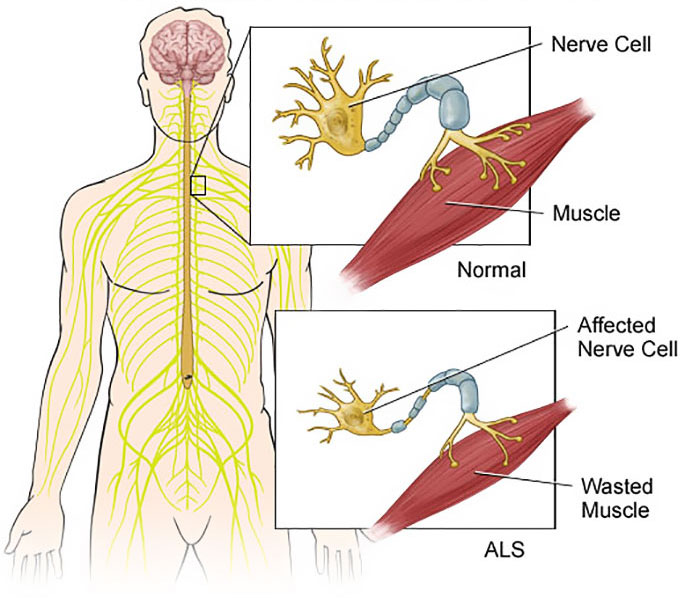 Remember The Ice Bucket Challenge? It Just Funded A Major Breakthough In ALS Research Remember The Ice Bucket Challenge? It Just Funded A Major Breakthough In ALS Research