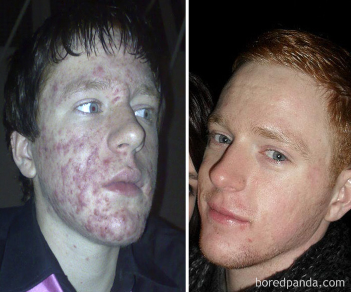 People Share Their Incredible “Ugly Duckling” Transformations And It’s Hard To Believe They’re The Same People People Share Their Incredible “Ugly Duckling” Transformations And It’s Hard To Believe They’re The Same People