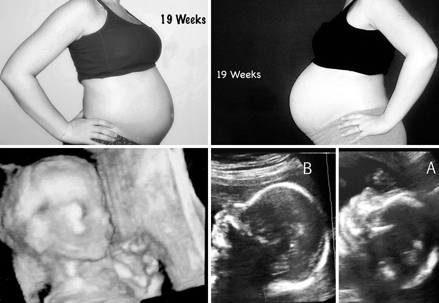 Side By Side Comparison Of My Singleton Pregnancy And My Twin Pregnancy