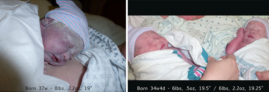 Side By Side Comparison Of My Singleton Pregnancy And My Twin Pregnancy