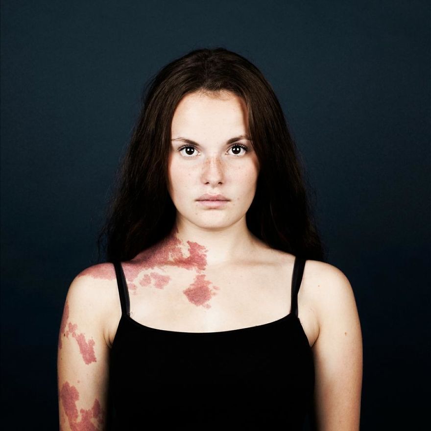 19 Portraits Of People With Birthmarks That Might Change The Way You See Them