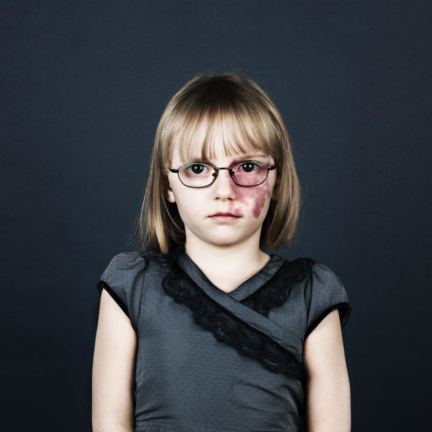 19 Portraits Of People With Birthmarks That Might Change The Way You See Them