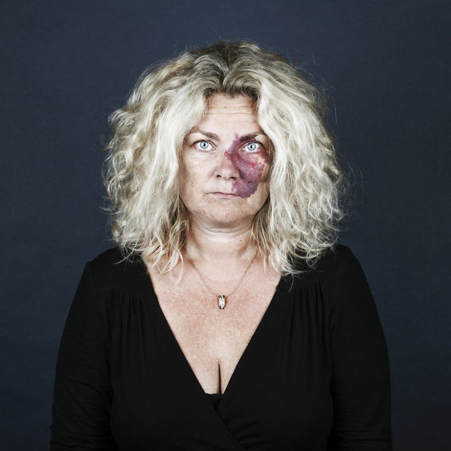 19 Portraits Of People With Birthmarks That Might Change The Way You See Them