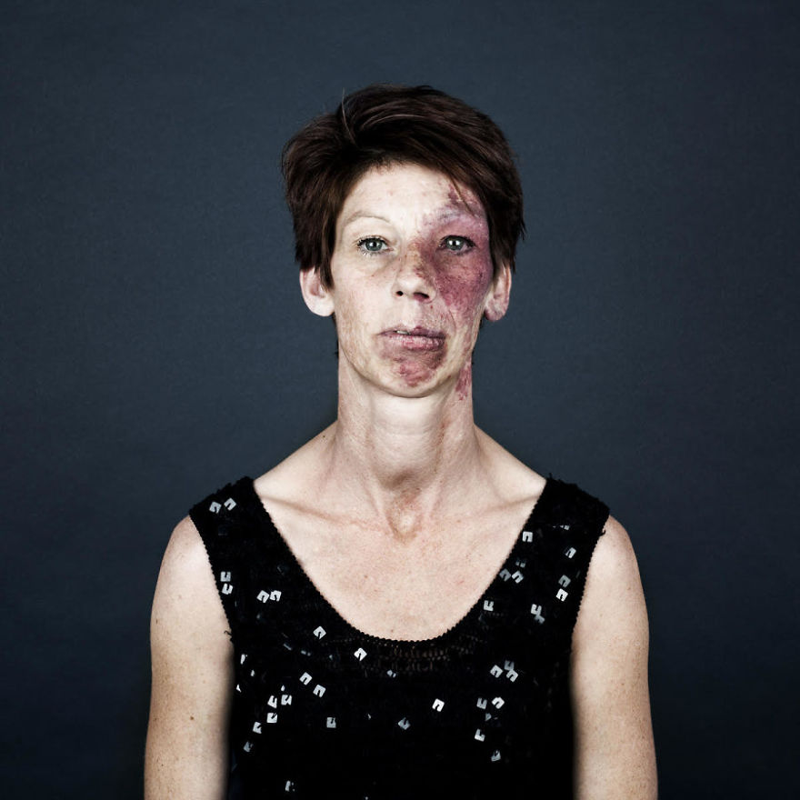 19 Portraits Of People With Birthmarks That Might Change The Way You See Them