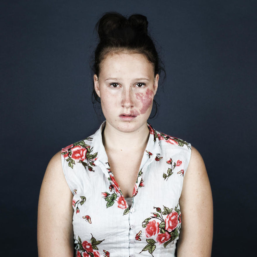 19 Portraits Of People With Birthmarks That Might Change The Way You See Them