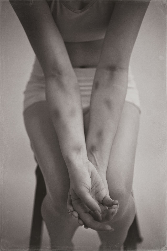 I Contracted Spinal Viral Meningitis After A Photoshoot In A Swamp, And This Art Series Capture My Battle Against It (NSFW)