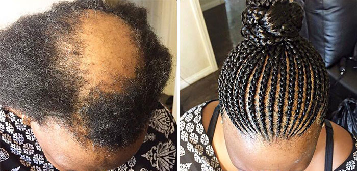 Men Are Hiding Baldness With Man Buns, But It’s Riskier Than You Think