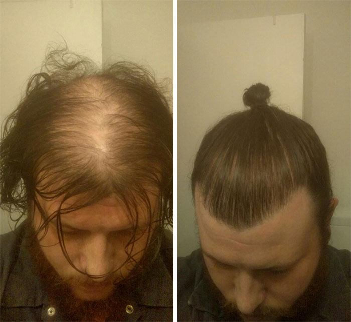 Men Are Hiding Baldness With Man Buns, But It’s Riskier Than You Think