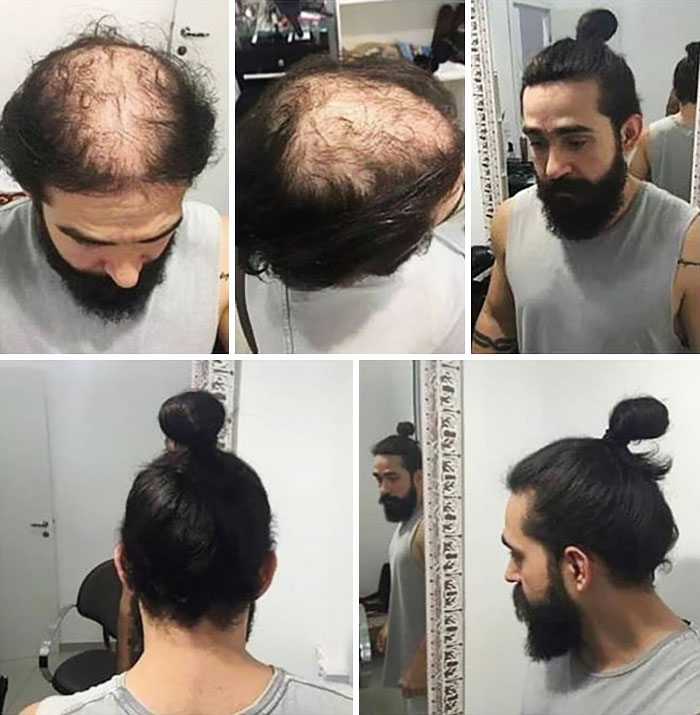 Men Are Hiding Baldness With Man Buns, But It’s Riskier Than You Think