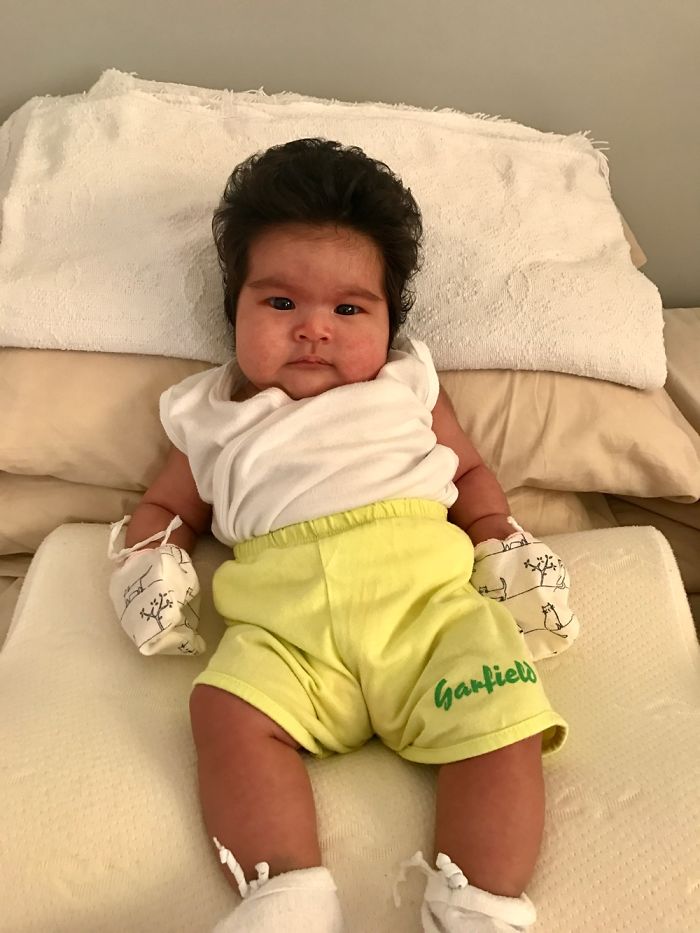 Hairy 2-Month-Old Baby Girl