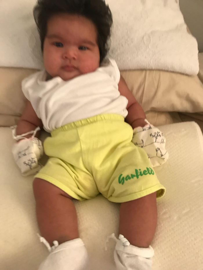 Hairy 2-Month-Old Baby Girl