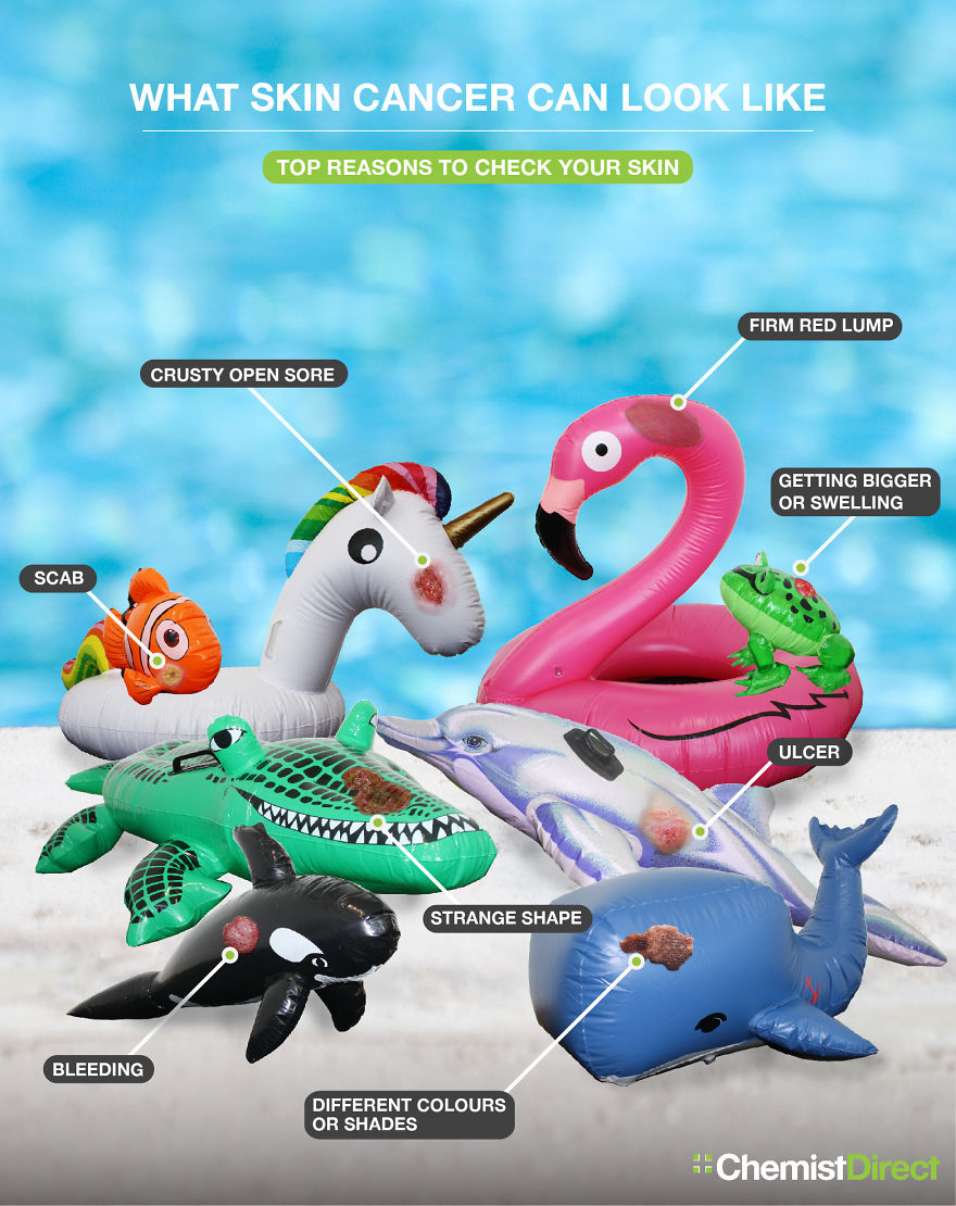 Skin Cancer On Inflatables: 8 Of The Most Common Symptoms Of Skin Cancer