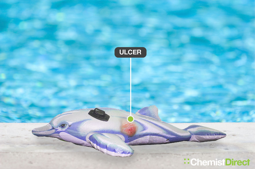 Skin Cancer On Inflatables: 8 Of The Most Common Symptoms Of Skin Cancer