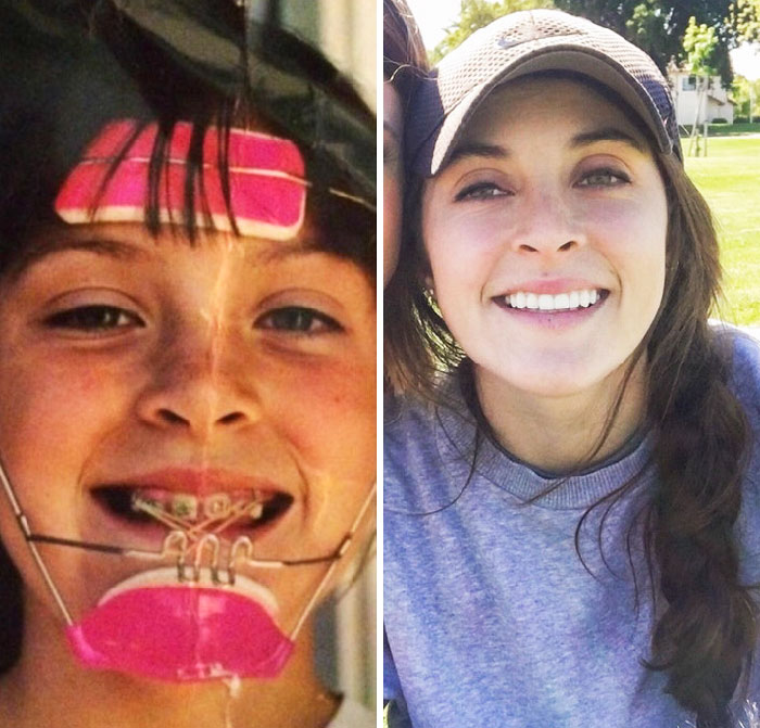 People Who Used To Be “Ugly Ducklings” Share Their Transformations, And We Can Barely Recognize Them (New Pics) People Who Used To Be “Ugly Ducklings” Share Their Transformations, And We Can Barely Recognize Them (New Pics)