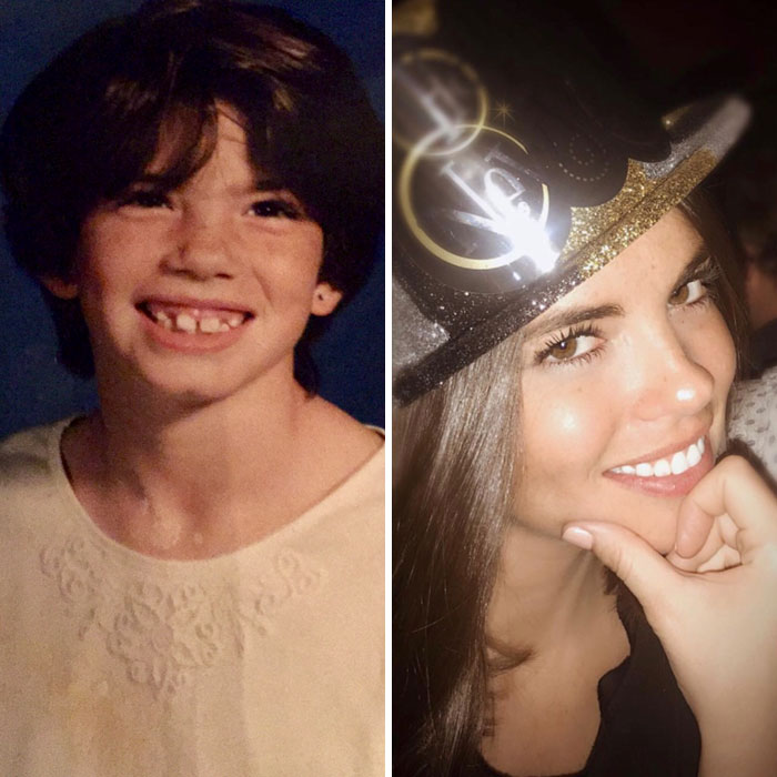 People Who Used To Be “Ugly Ducklings” Share Their Transformations, And We Can Barely Recognize Them (New Pics) People Who Used To Be “Ugly Ducklings” Share Their Transformations, And We Can Barely Recognize Them (New Pics)