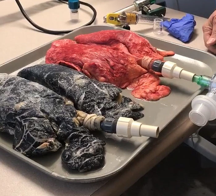 Shocking Video Of Nurse Inflating Healthy Lungs Vs Smoker’s Reveals What Cigarettes Really Do To You Shocking Video Of Nurse Inflating Healthy Lungs Vs Smoker’s Reveals What Cigarettes Really Do To You