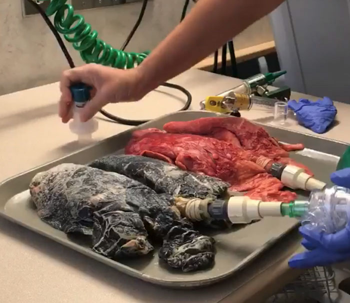 Shocking Video Of Nurse Inflating Healthy Lungs Vs Smoker’s Reveals What Cigarettes Really Do To You Shocking Video Of Nurse Inflating Healthy Lungs Vs Smoker’s Reveals What Cigarettes Really Do To You