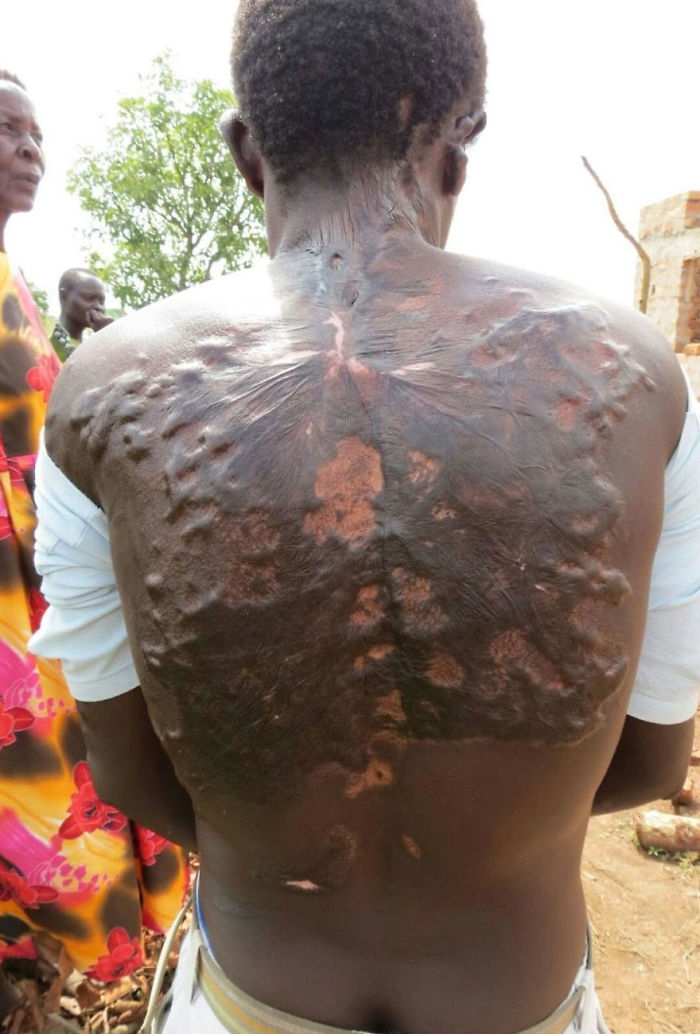 Lichtenberg Scars — Nature’s Tattoo You Don’t Want To Have Lichtenberg Scars — Nature’s Tattoo You Don’t Want To Have