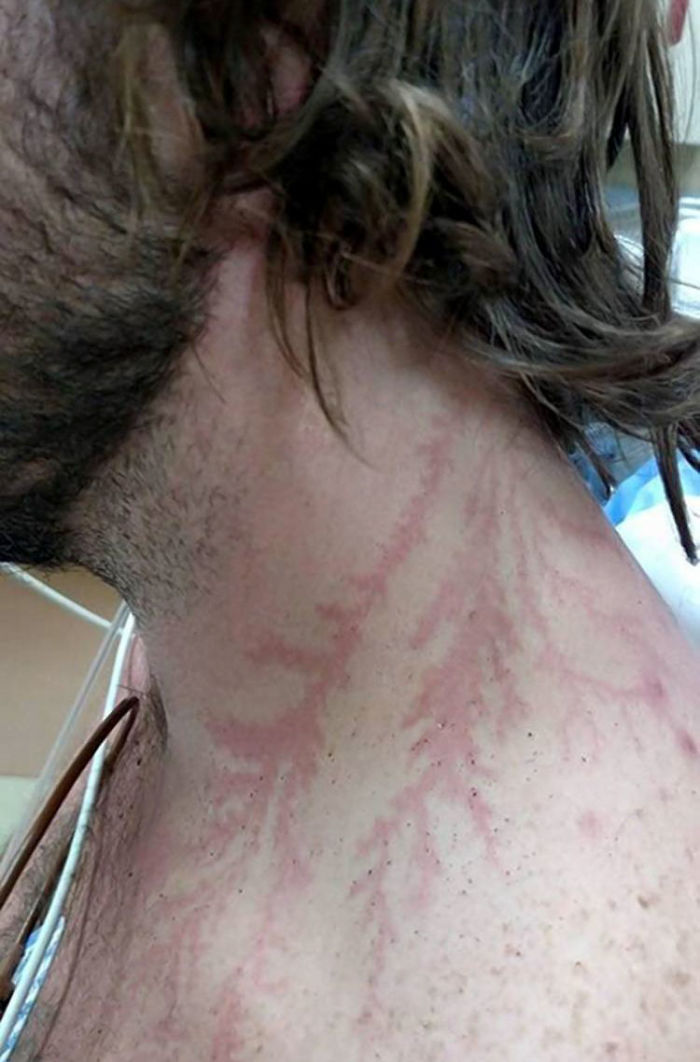 Lichtenberg Scars — Nature’s Tattoo You Don’t Want To Have Lichtenberg Scars — Nature’s Tattoo You Don’t Want To Have