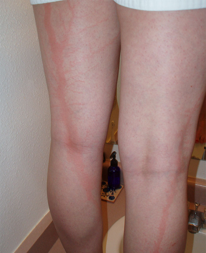 Lichtenberg Scars — Nature’s Tattoo You Don’t Want To Have Lichtenberg Scars — Nature’s Tattoo You Don’t Want To Have
