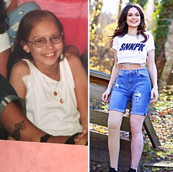 Girl Gets Her Leg Amputated At Age 11 Because Of Cancer, Becomes A Model 20 Years Later Girl Gets Her Leg Amputated At Age 11 Because Of Cancer, Becomes A Model 20 Years Later