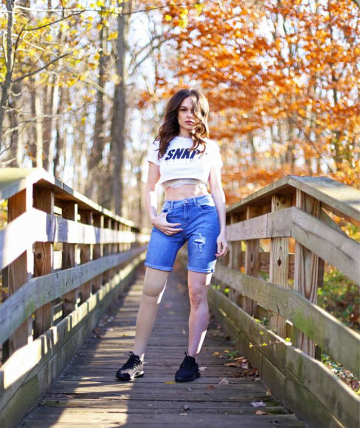 Girl Gets Her Leg Amputated At Age 11 Because Of Cancer, Becomes A Model 20 Years Later Girl Gets Her Leg Amputated At Age 11 Because Of Cancer, Becomes A Model 20 Years Later