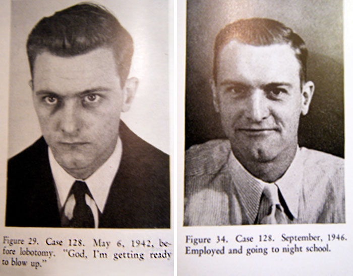 21 Disturbing Pictures of Lobotomy Before and After 21 Disturbing Pictures of Lobotomy Before and After