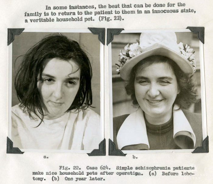21 Disturbing Pictures of Lobotomy Before and After 21 Disturbing Pictures of Lobotomy Before and After