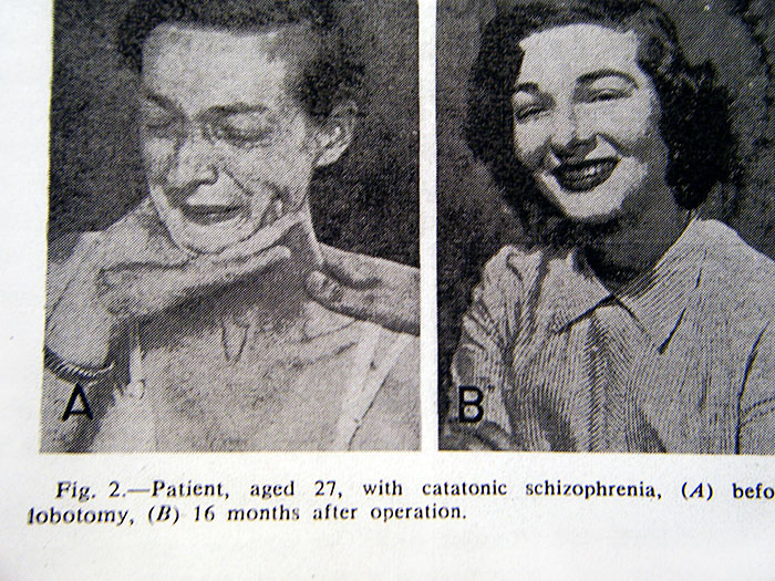 21 Disturbing Pictures of Lobotomy Before and After 21 Disturbing Pictures of Lobotomy Before and After