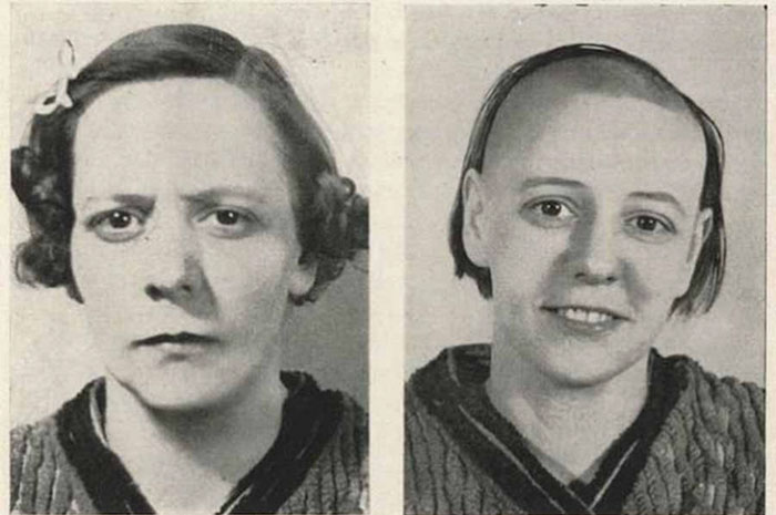 21 Disturbing Pictures of Lobotomy Before and After 21 Disturbing Pictures of Lobotomy Before and After