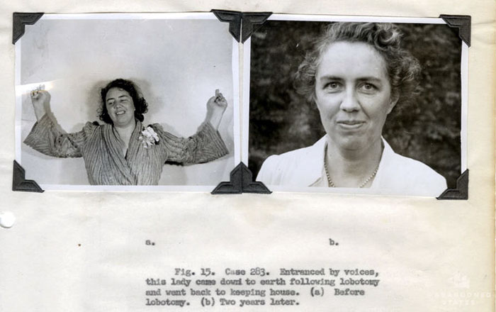 21 Disturbing Pictures of Lobotomy Before and After 21 Disturbing Pictures of Lobotomy Before and After