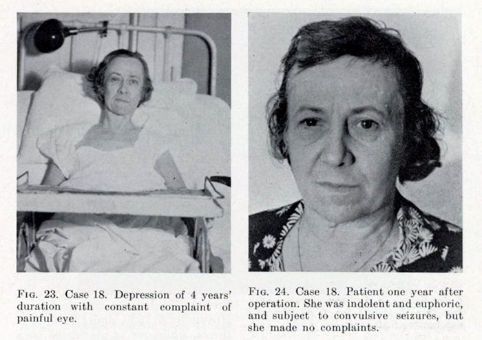 21 Disturbing Pictures of Lobotomy Before and After 21 Disturbing Pictures of Lobotomy Before and After