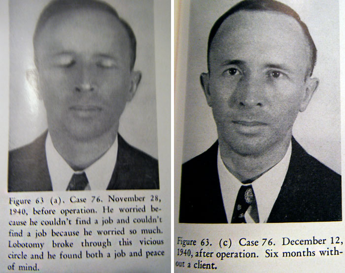 21 Disturbing Pictures of Lobotomy Before and After 21 Disturbing Pictures of Lobotomy Before and After