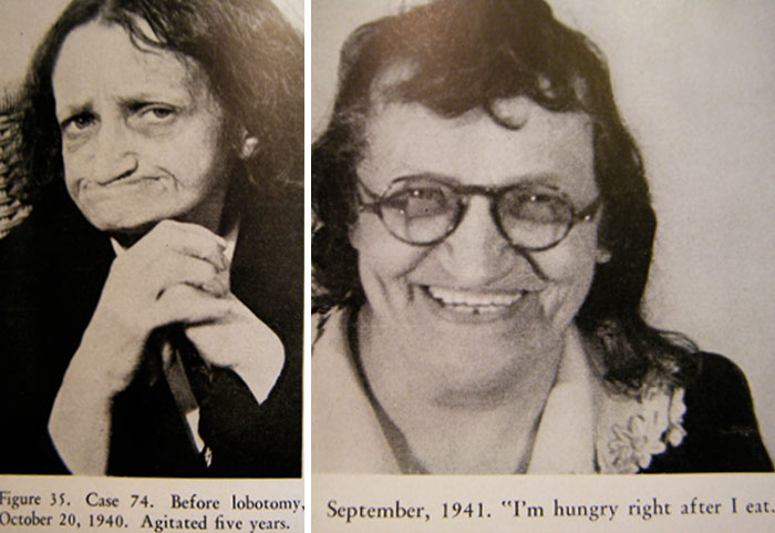 21 Disturbing Pictures of Lobotomy Before and After 21 Disturbing Pictures of Lobotomy Before and After