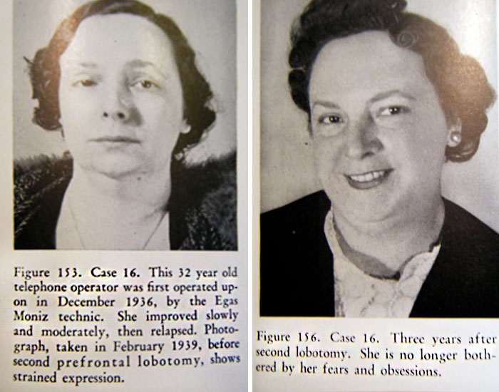 21 Disturbing Pictures of Lobotomy Before and After 21 Disturbing Pictures of Lobotomy Before and After