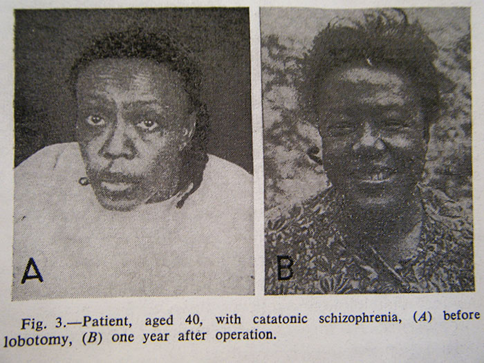 21 Disturbing Pictures of Lobotomy Before and After 21 Disturbing Pictures of Lobotomy Before and After