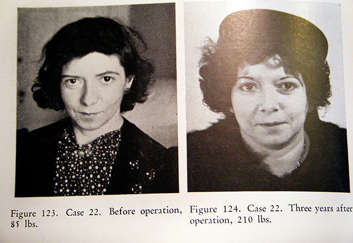 21 Disturbing Pictures of Lobotomy Before and After 21 Disturbing Pictures of Lobotomy Before and After