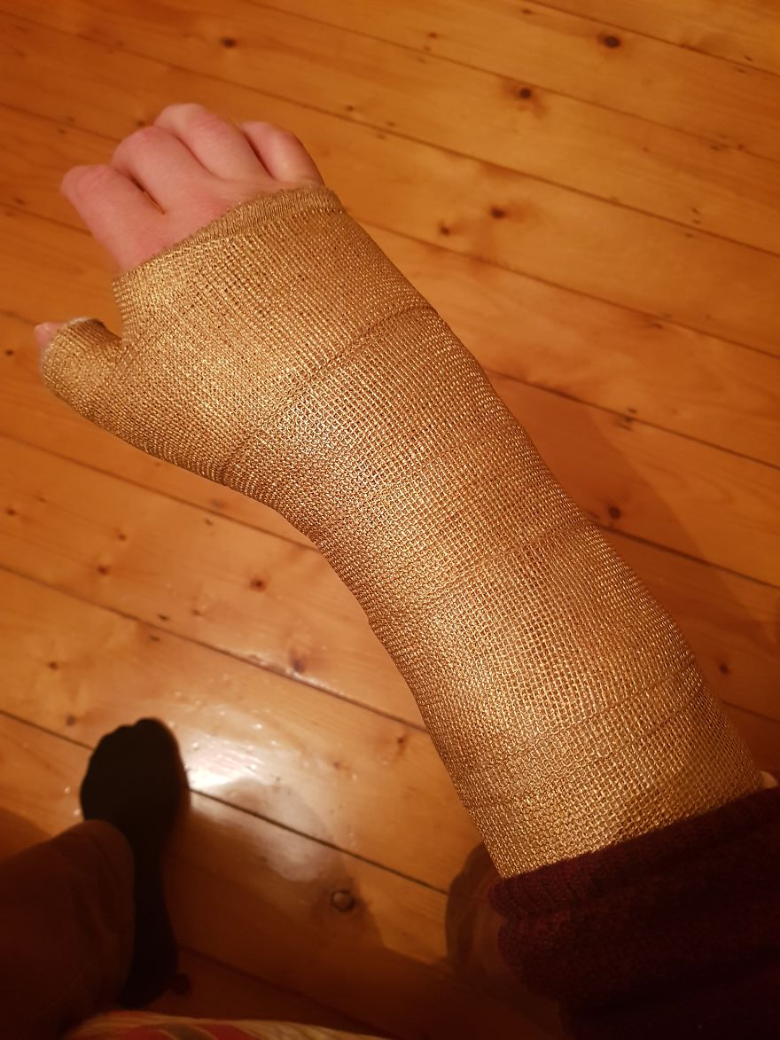 After Breaking My Wrist, I Turned My Plain Cast Into Thanos‘ Infinity Gauntlet After Breaking My Wrist, I Turned My Plain Cast Into Thanos‘ Infinity Gauntlet