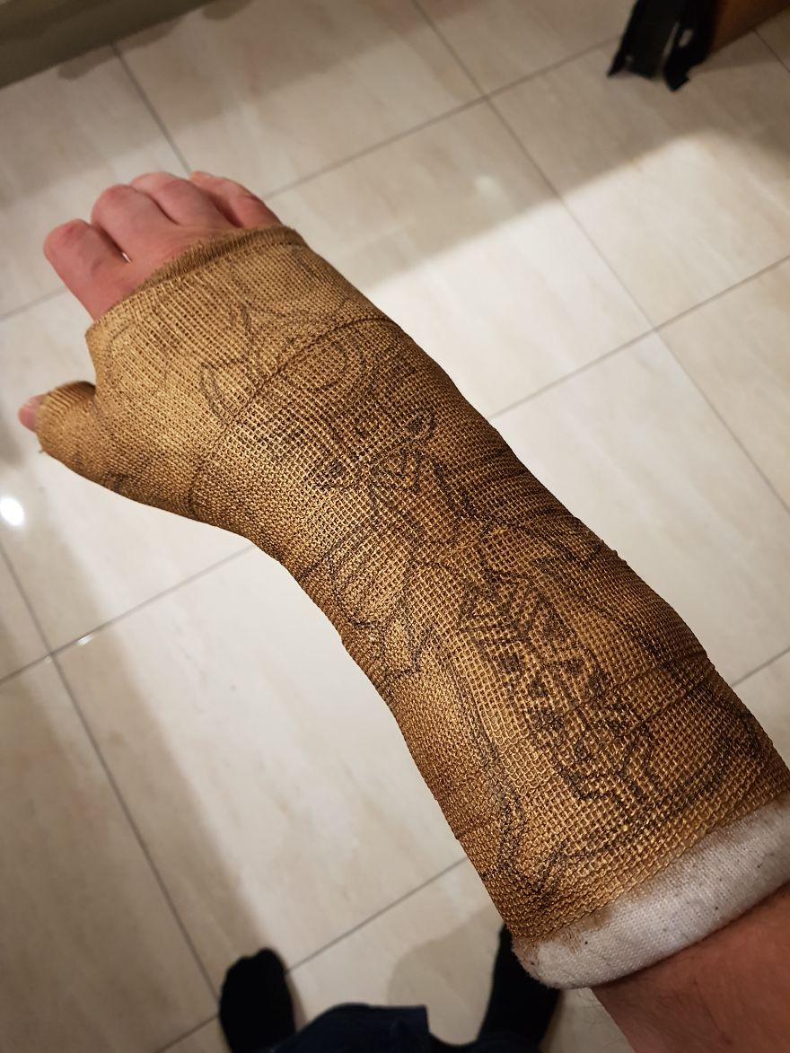 After Breaking My Wrist, I Turned My Plain Cast Into Thanos‘ Infinity Gauntlet After Breaking My Wrist, I Turned My Plain Cast Into Thanos‘ Infinity Gauntlet