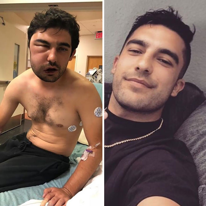 38 Stunning Before &#038; After Transformations Of People Who Quit Drugs