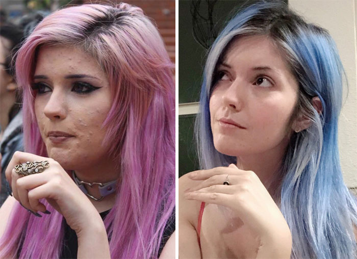 People Call This 25-Year-Old A Liar Because Of How Well She Cured Her Acne, So She Posts A Video To Prove It