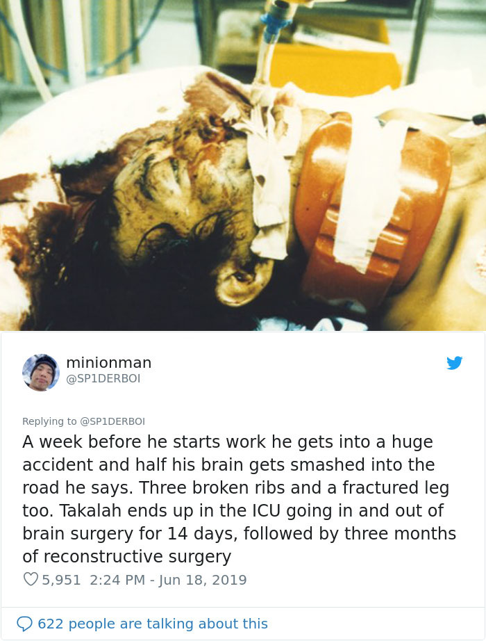 Man Given 0.1% Chance By Doctors After Motorbike Accident Where He Lost Half Of His Brain Makes Incredible Recovery Man Given 0.1% Chance By Doctors After Motorbike Accident Where He Lost Half Of His Brain Makes Incredible Recovery